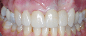 Smile Makeover - More Extensive - After - Edinburgh Dentist