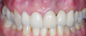 Smile Makeover - More Extensive - Before - Edinburgh Dentist