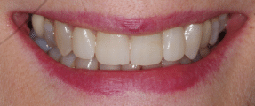 Smile Makeover - More Extensive - After - Edinburgh Dentist