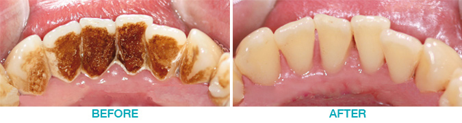 dental hygiene  before and after