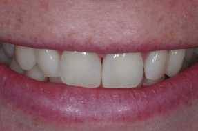 Mini Makeover - after - Edinburgh Dentist