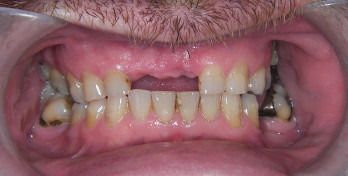 Before Dentures Edinburgh