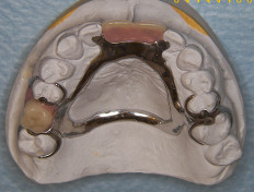 Denture Impression Edinburgh